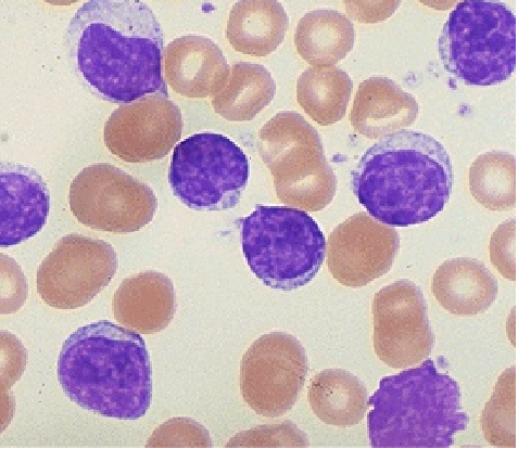 Leukemie en lymfoom